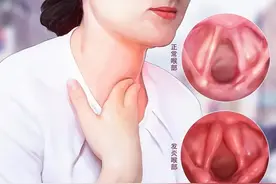 总是声音嘶哑？可能是慢性喉炎图片