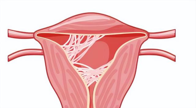 25-35岁女性反复人流，小心宫腔粘连，出现6类症状，及时就医
