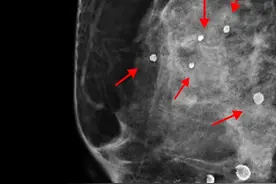 这个检查要把胸“捏扁”，平胸的咋办啊？图片