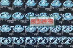 六旬老太咽颈部肿瘤 山西医科大学第一医院外科完整切除获成功图片