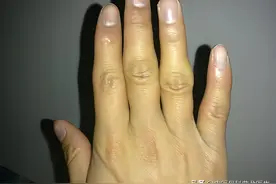 手指关节处有一个凸起的包是怎么回事？图片