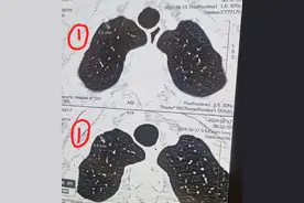 双肺多发磨玻璃结节随访四年半求结果，精准诊断三个原位不急手术图片