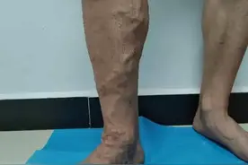 二十年静脉曲张老顽疾无痛微创术后很轻松图片