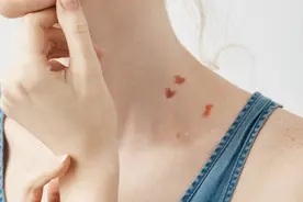 脸上长了这样的“小肉揪”，跟私生活有关吗？图片