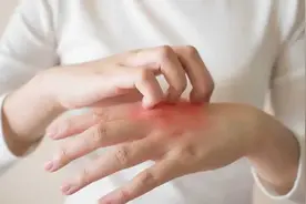 一群人里，为啥蚊子偏偏就咬你?与血型无关，真正的原因是什么？图片