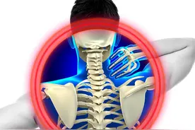 颈5-6椎间盘突出了，该怎么办？有什么效果好的治疗方法吗？图片