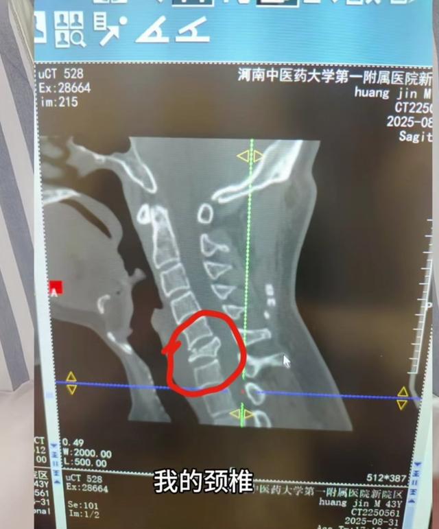 方特过山车上热搜！中医大夫自曝坐完颈椎骨折，网友讲述同样经历