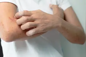 湿疹不会无故复发，医生直言：湿疹复发的人，大多是这5事没做好图片