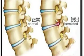 北京顺义治疗椎间盘突出手术和护理须知图片