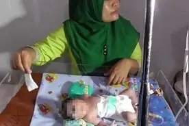 回顾：印尼妇女生下“独眼婴儿”，无嘴、无鼻，出生就注定死亡图片