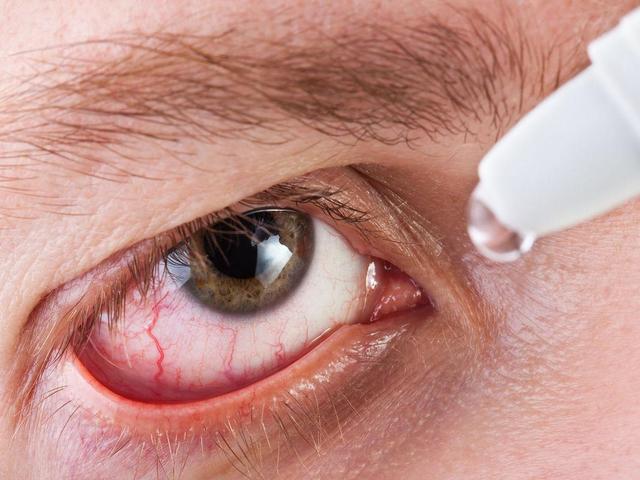 眼角经常发痒，却没有红肿？可能在提醒你这5个健康隐患