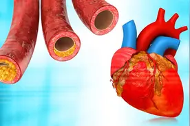 心脏血管虽然重度狭窄了，但没有任何症状，还需要做支架手术吗？图片