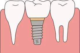 种牙须知，种植牙的一、二、三期分别代表什么？图片
