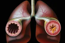 支气管扩张痰多？乙酰半胱氨酸+排痰法，咳痰更轻松！图片