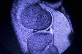 困扰膝关节病问题最多的是半月板损伤，今天提出几点供大家参考图片