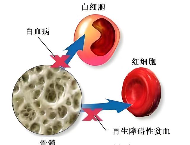 白血病最后人是怎么没的？医生实话实说：多数是因为这几个并发症