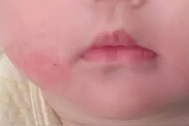 娃频繁流口水？警惕“口水疹”来袭...图片
