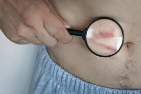 带状疱疹后遗神经痛，疼得睡不着？皮肤科医生教你4招止痛图片