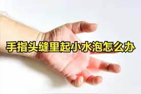 手指头缝里起小水泡怎么办图片