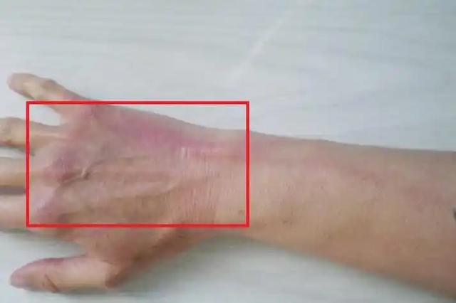 血管年轻,人才年轻!手背血管有这6个特点,恭喜你容易长寿