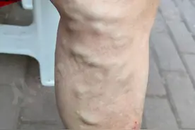 警惕｜夏日来临，别让静脉曲张“毁”了你的双腿图片