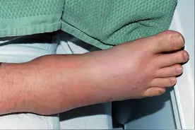 脚部出现这几种症状，别当是小病，医生：拖久了，病情恶化难治愈图片