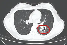 热搜第一！女子高烧40℃，肺部“长满”霉菌！这个细节千万警惕图片