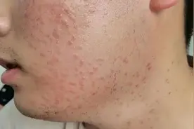皮肤上这种小颗粒不是粉刺，是HPV感染！几乎50%的人都长过→图片