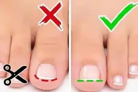 好痛！脚趾甲嵌进肉里怎么办？其实一坨棉花就可以解决！图片