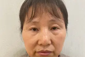 53岁一时冲动，去做了眼袋手术，没想到一个礼拜后是这样！图片