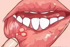 口腔溃疡折腾的我，不能张嘴说话图片