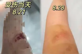 擦伤膝盖胳膊腿，怎么护理才能不留疤？摔伤后护理全过程实录图片