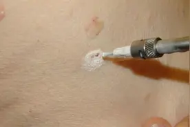 不论男女，身上长这5种“瘊子”，或许已感染HPV！不要忽略！图片