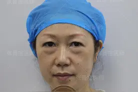 46岁把眼袋手术给做了，术后17天成这样，前后对比像两人图片