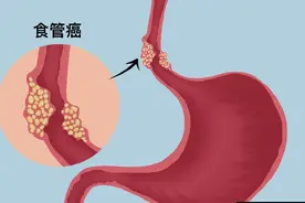 医生：食管开始癌变的第一信号，通常在嗓子？很多人都没有放心上图片