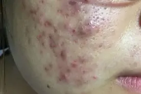 热门祛痘膏大测评！还是国货更胜一筹，7天彻底远离痤疮痘痘！图片