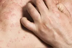 孩子皮肤过敏频繁，可能是这些原因，皮肤科医生提醒家长图片