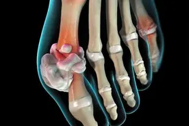 隐形“嘌呤大户”被揪出！不想尿酸升高，这5种食物少碰图片