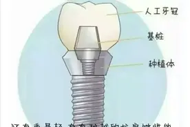 当牙齿缺失时，你选择种植牙还是镶牙呢？关于种植牙的那些事图片
