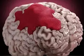 脑溢血发生前会有5个“前兆”，出现一个以上，需尽早就医！图片