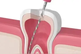 同样是根管治疗，为什么有的贵有的便宜图片