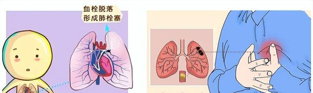 马上停止7类运动，很可能加速血栓形成！等血管“堵死”就迟了