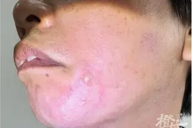 它被称为“飞行的硫酸”，浙江王女士随手一拍差点毁容！图片