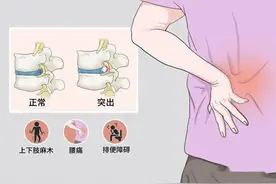腰椎间盘突出，痛苦不堪，牢记4字口诀！图片