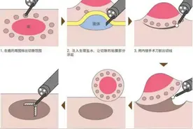 肠道早癌不可怕，内镜微创保平安图片