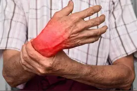 风湿病人要不要“忌口”？图片