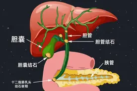 成都肝胆结石医院提醒：胆结石无症状是好事？不痛不痒更应警惕图片
