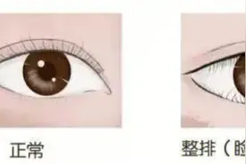 倒睫到底是什么原因导致的？能不能根治？图片