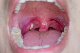 扁桃体结石图片