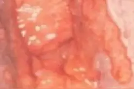 生殖器疱疹-私密处传染病，小心中招图片